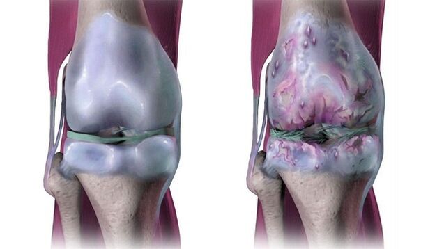 Articulación de la rodilla sana y afectada por la osteoartritis. 