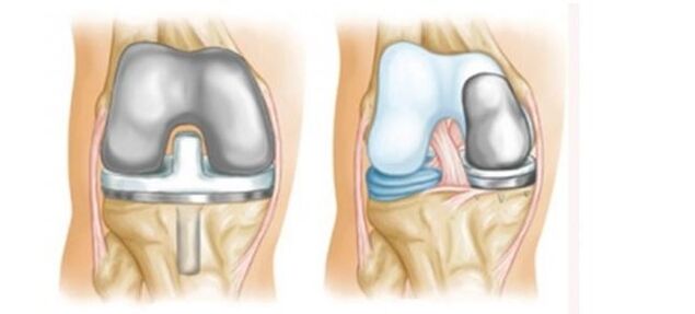 artroplastia para la osteoartritis de la articulación de la rodilla