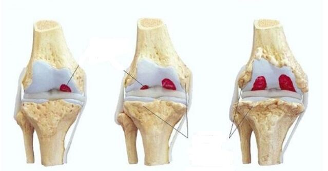 etapas de la osteoartritis de la articulación de la rodilla