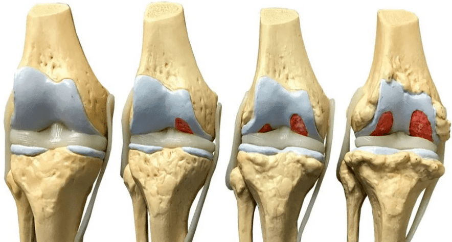Daño a la articulación de la rodilla en diferentes etapas del desarrollo de la artrosis. 