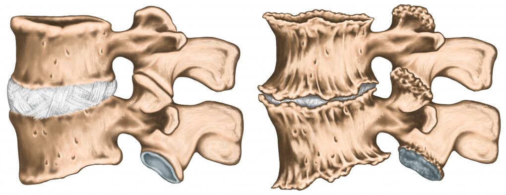 dolor de espalda debido a una lesión en la columna