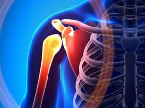 Articulación del hombro inflamada debido a artrosis una enfermedad crónica del sistema musculoesquelético