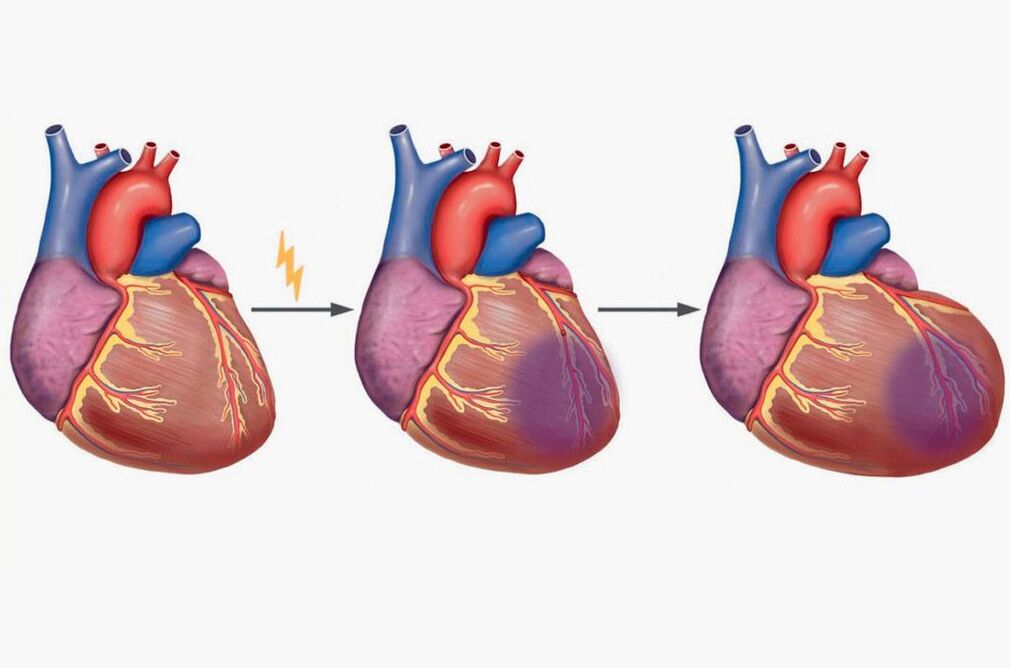 El infarto de miocardio provoca dolor en el omóplato