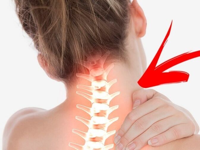 Compresión de las raíces nerviosas con osteocondosis cervical