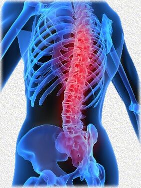 osteocondrosis y métodos de su tratamiento.