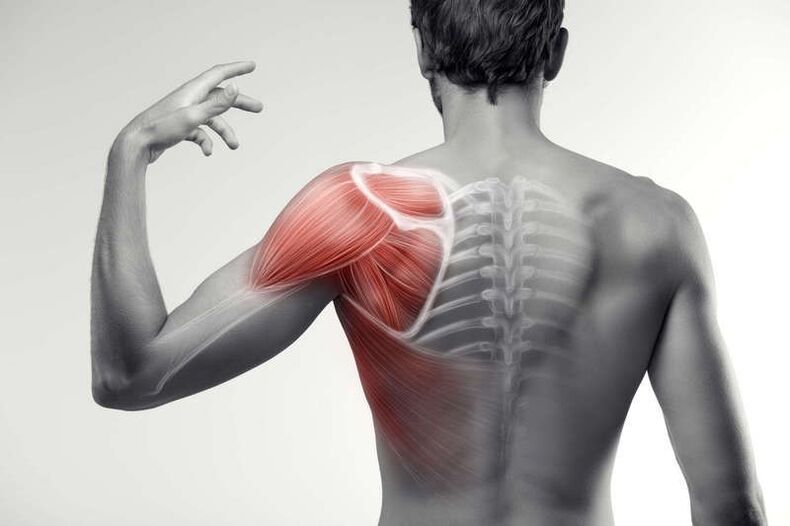áreas de dolor muscular