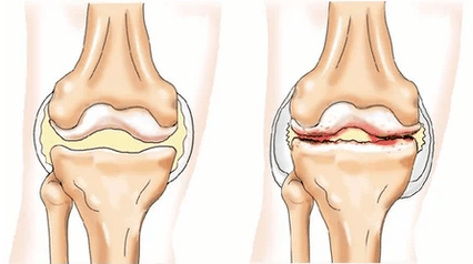 Condromatosis